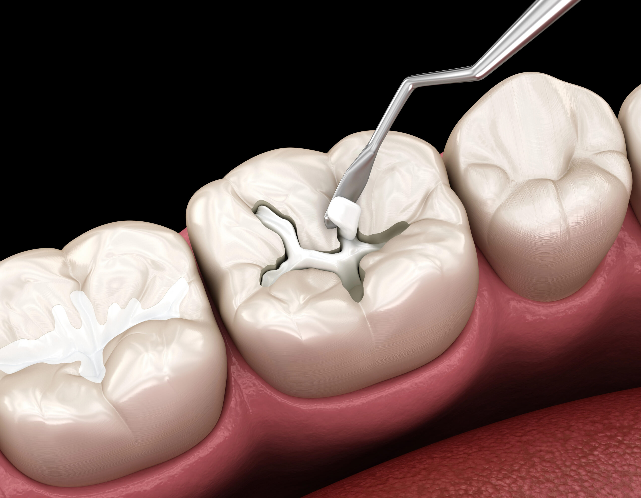 General Dentist for Dental Fillings: Simple Solutions for Cavities and Decay